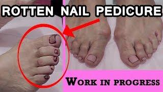 NAIL SUNNY: rotten nails pedicure
