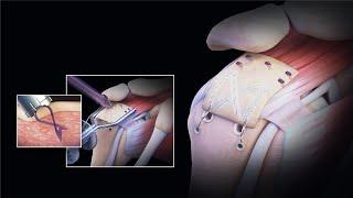 CuffMend™ Rotator Cuff Repair Augmentation System