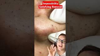 First Ever BLACKHEAD REMOVAL 2025 - Super Satisfying #shorts