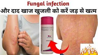 KZ Powder|फंगल इंफेक्शन और दाद खाज खुजली को करें जड़ से खत्म|Anti Fungal Powder For Itching Problem|