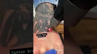 Tattoo Removal with Picosure Laser
