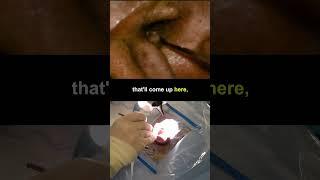 Stapedotomy (Endaural) #medicine #ENT #doctor #anatomy #science #hospital #medical #learn #watch