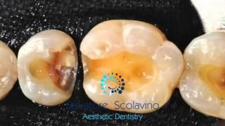 Cavity preparation in posteriors