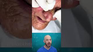 Huge pores mean seriously satisfying blackhead pops (credit: @blackheadsremoval11on TT)#satisfying