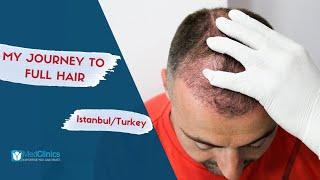 Hair Transplantation in Turkey | Sapphire Fue Hair Transplant