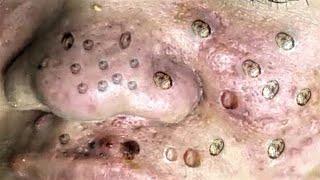 Big Cystic Acne Blackheads Extraction Blackheads & Milia, Whiteheads Removal Pimple Popping #