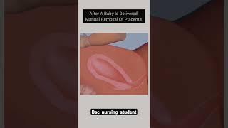 Manual Removal Of Placenta..#baby #doctor#aiimshospital #dilevery #shortvideo #stutas #bscnursing