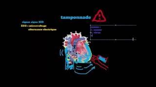 SmartN'Easy Cardio - Tamponnade - Dr Astuce