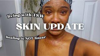 SKIN UPDATE : Eczema Journey & Living w/ TSW