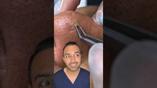 OMG I was not expecting that blackhead extraction on the nose! Dr Somji reacts