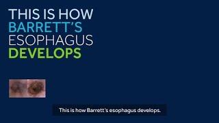 What is Barrett’s Esophagus?