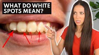 What are WHITE SPOTS on Teeth Telling YOU?