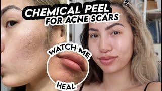 I TRIED A CHEMICAL PEEL FOR ACNE SCARS...this is how it went!