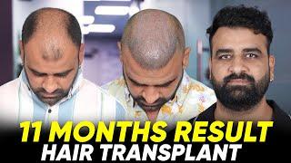 Hair Transplant in Chennai | Best Results & Cost of Hair Transplant in Chennai