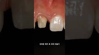 앞니 지르코니아 크라운 치료 (Zirconia crown treatment in anteroir tooth)