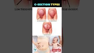 C Section Secrets Revealed  Pregnancy Delivery option | Painless delivery option | Cesarean Section