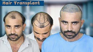 Hair Transplant in Bhopal | Cost of Hair Transplant in Bhopal | Hair Transplant Doctor in Bhopal