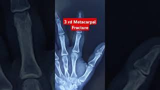 3 rd Metacarpal Fracture.. Dr Sai Chandra MBBS DNB Ortho Hyderabad