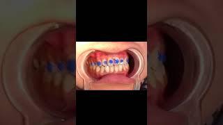 How we will Put Braces on tooth|Fixed Braces |Metallic Braces|Fixation of Braces