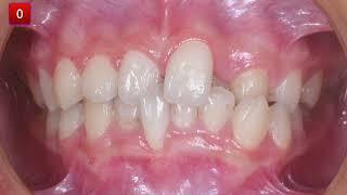 Treatment of Skeletal Class I Malocclusion with Invisalign｜【Chris Chang Ortho】CC809