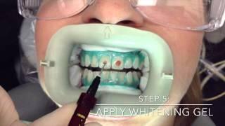 Professional In-Office Teeth Whitening by Mint Dental OC in Yorba Linda, Orange County