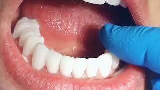 Miami Zirconia Crowns Try in - Dr.Svetlana Anokhina DDS