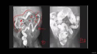 HOW TO APPROACH RADIOLOGICALLY INFANTS WHO  FAIL TO PASS MECONIUM WITH DIFFERENTIALS & CATCH POINT