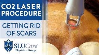 CO2 Laser Resurfacing Treatment For Getting Rid of Scars - Full Procedure