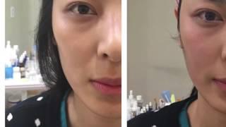 Beauty Monster (with Fractional tip) - Pore, Lifting, Brightening
