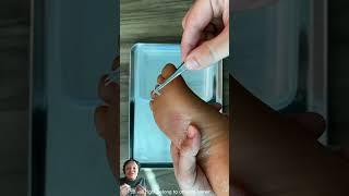 Got Glass in Your Foot? Try This Genius Trick