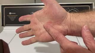 Cubital Tunnel and Carpal Tunnel Release Surgery - Pain Management (post surgery)