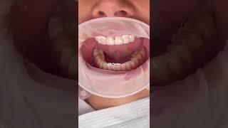 Dental veneers procedure step by step | dental veneers before and after | Dr. Yazdan #veneers