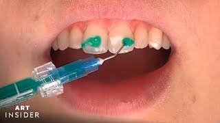 How White Teeth Spots Are Removed