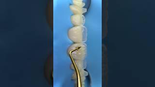 Dental motivation. Composite veneers. Direct composite restoration front teeth. #dental #dentistry