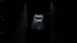 midline prostatic cyst#imaging #ultrasound #medicalimaging #learning #medicine #viral #doctor