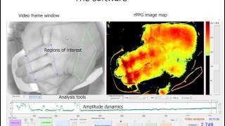 Photoplethysmography imaging algorithm for continuous monitoring of regional anesthesia