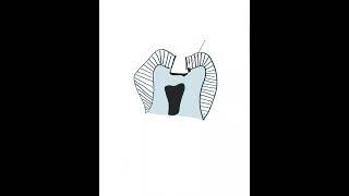 Residual Caries