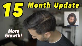 15 Month 2nd Hair Transplant Update | 4000 GRAFTS FUE | MORE GROWTH