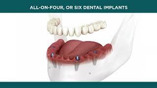 Lorton Springfield Dental Implant & Oral Surgery - All on 4 Dental Implant Treatment