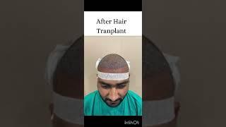 Hair Transplant at Radiant Clinic #beforeafter #indore #customerexperience #hairtransplantsurgery #