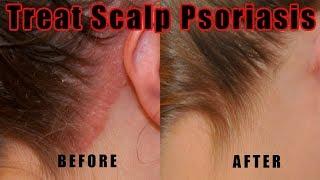 How to Treat Scalp Psoriasis – 5 Natural Ways for Treating Psoriasis of the Scalp at Home