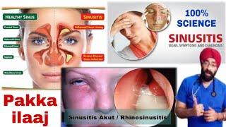 साइनस | Sinusitis : Permanant Cure & Cause | Explained in Hindi by Dr.Education