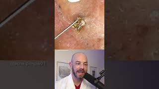 Derm reacts to massive blackhead removal! #dermreacts #doctorreacts #blackheadextraction