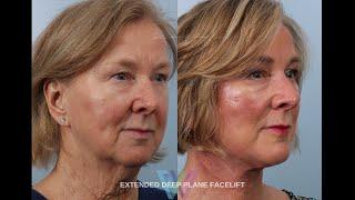 Deep Plane Facelift Testimonial | Revitalized Reflections