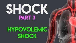 Hypovolemic Shock | Shock (Part 3)