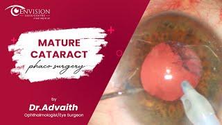 Mature Cataract - Phaco surgery | Cataract Eye Surgery | Best Eye Surgery Specialist in Hyderabad