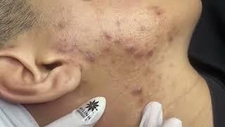 relaxing acne treatment everyday with vu quynh mi spa|blackheads removal| cystic removal 2023 new