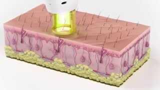 GentleMax Pro Laser Hair Removal for All Skin Tones