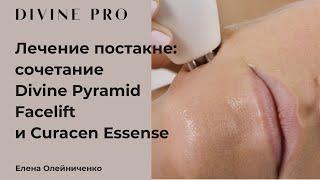 Лечение постакне: сочетание Divine Pyramid Facelift и Curacen Essence