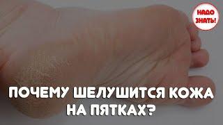 Почему шелушится кожа на пятках?